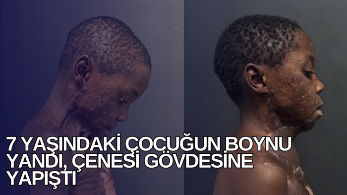 7 yaşındaki çocuğun boynu yandı, çenesi gövdesine yapıştı   